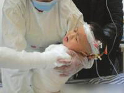 2歲男孩掉進(jìn)湯鍋重度燙傷
