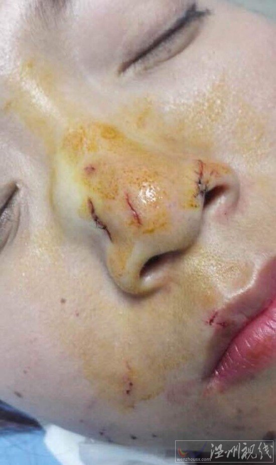 游客泰國吻蛇被咬