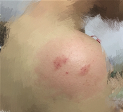 女子被蟲叮咬后休克