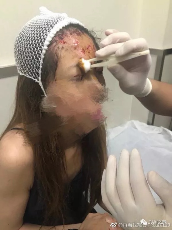 女模特坐快車毀容