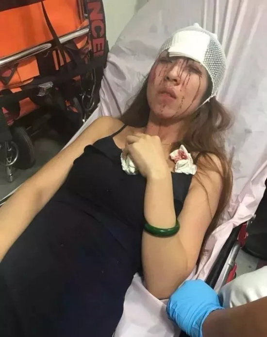 女模特坐快車毀容