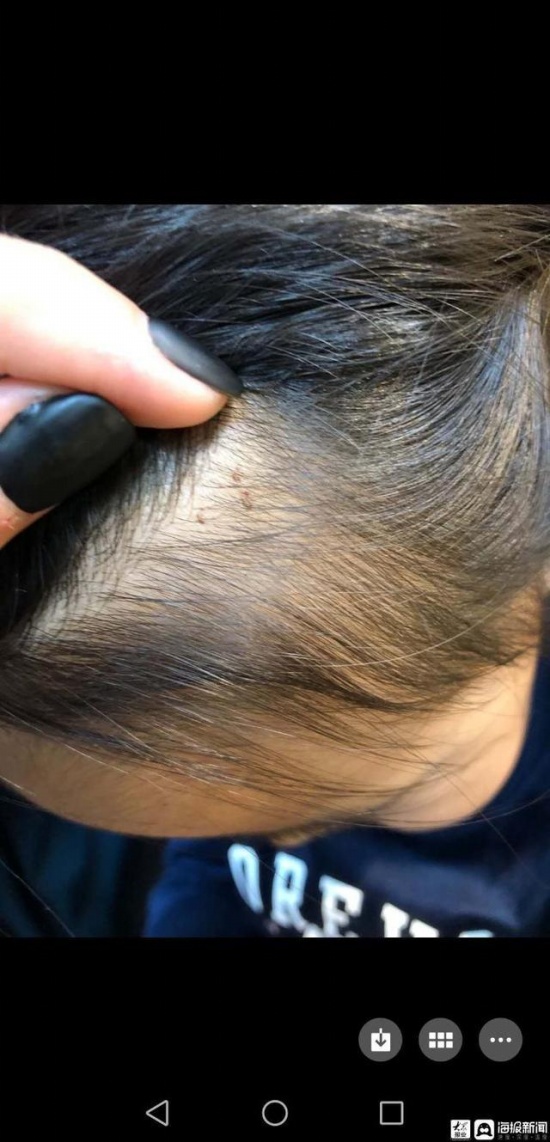 被針扎幼兒家長再發聲 呼和浩特鼎奇幼兒園虐待事件